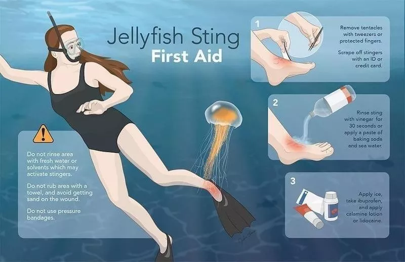 Jellyfish sting